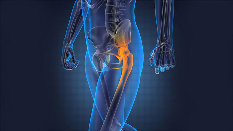 Avascular necrosis femoral head treated through Marmas..!
